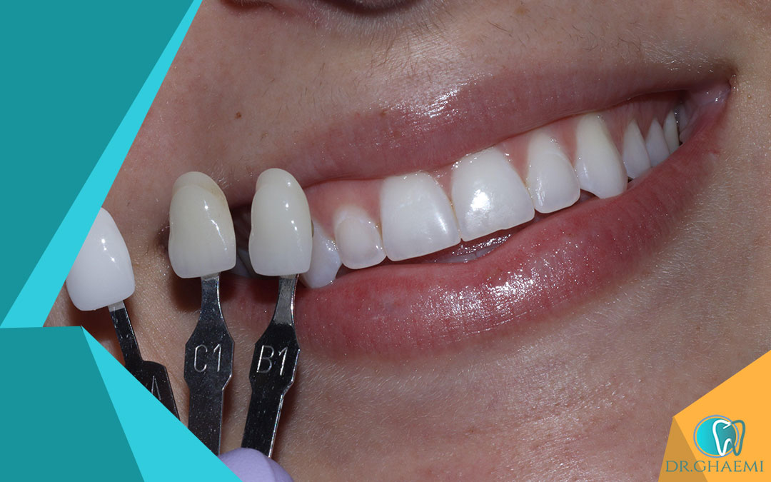 گزینه‌های درمان خطوط تیره در روکش دندان