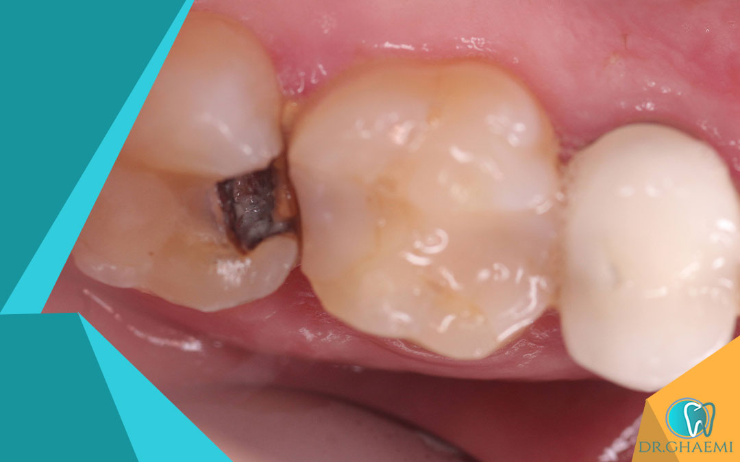 چرا باید آبسه دندان بعد از عصب کشی را سریع درمان کنیم؟