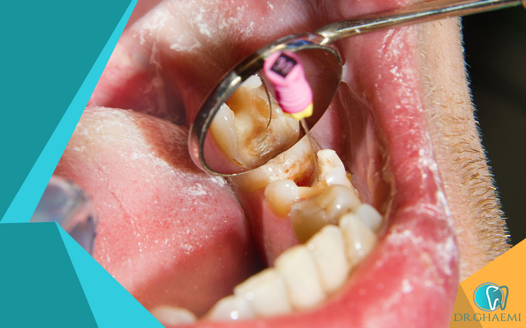چه زمانی جراحی ریشه دندان نیاز است؟