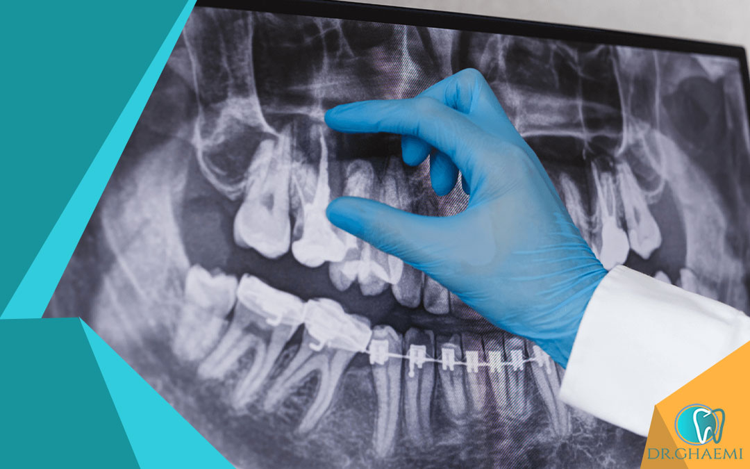 خطرات و عوارض بالقوه جراحی ریشه دندان