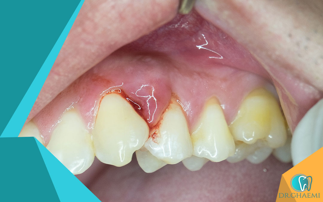 آیا خوردن آنتی بیوتیک به تنهایی برای درمان عفونت دندان عصب کشی شده کافی است؟