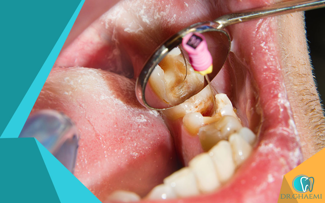 عفونت دندان عصب کشی شده چگونه تشخیص داده می‌شود؟