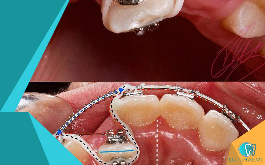 آیا ارتودنسی بدون کشیدن دندان امکان پذیر هست؟