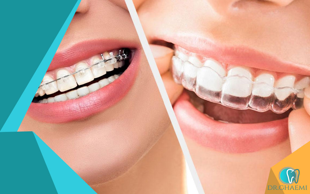 ارتودنسی بدون کشیدن دندان با باز کردن فضای بین دندان ها: