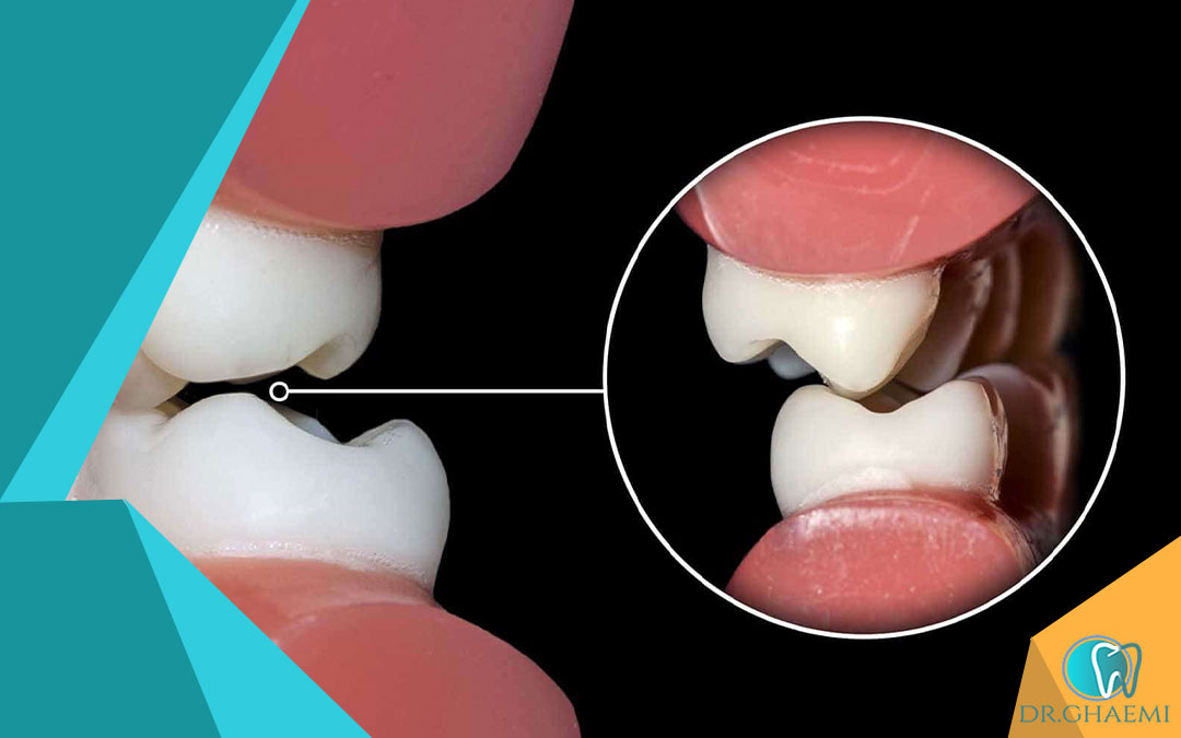 علائم دندان قروچه و دندان درد