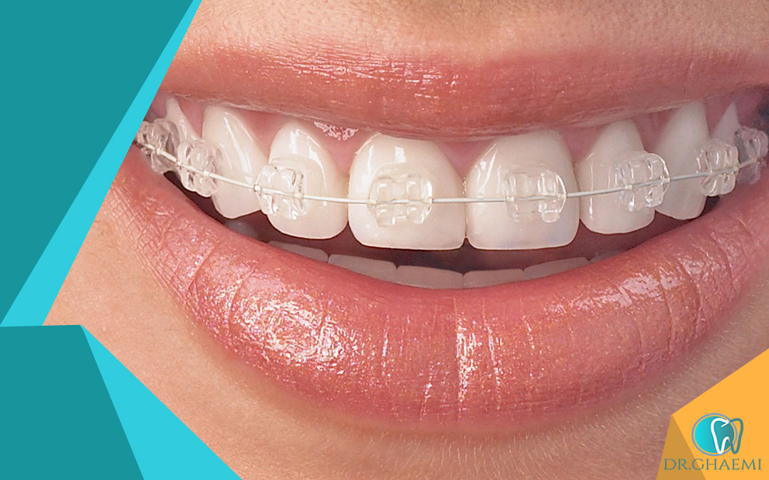 چرا ارتودنسی در کلینیک دندانپزشکی قائمی را انتخاب کنید؟