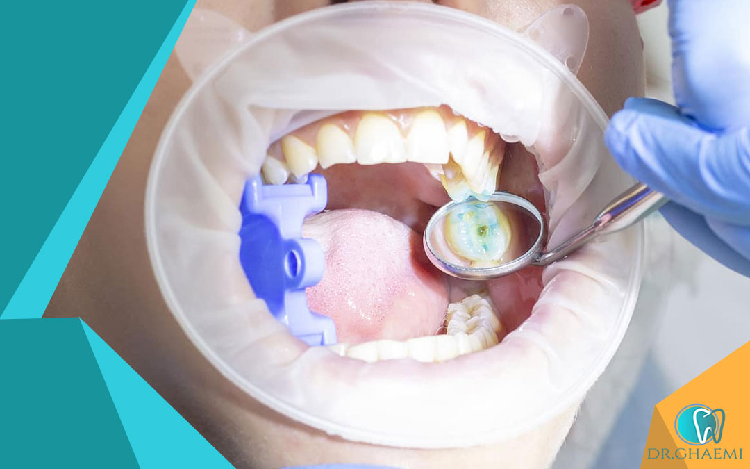 ارتباط کشیدن دندان عقل با ارتودنسی