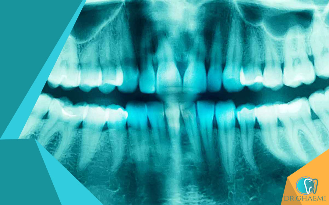 کشیدن دندان عقل برای ارتودنسی چه اهمیتی دارد؟