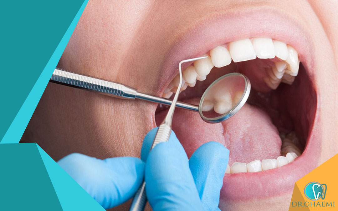 دندان‌های عقل و شکاف بین دندان‌ها: