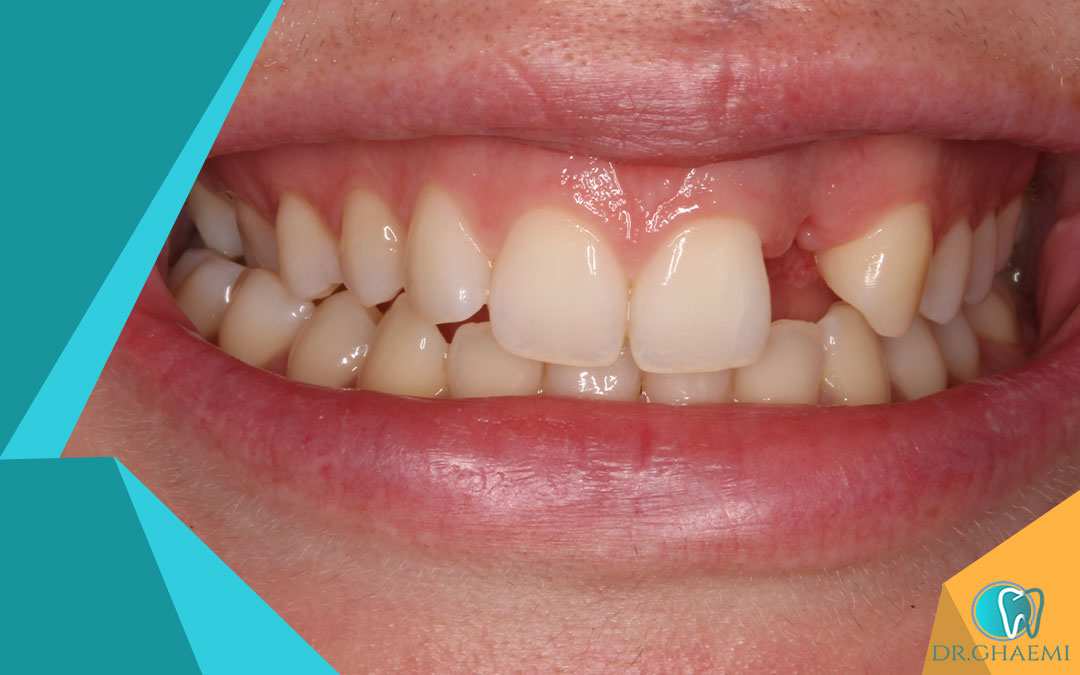 آشنایی با مراحل ارتودنسی یک دندان