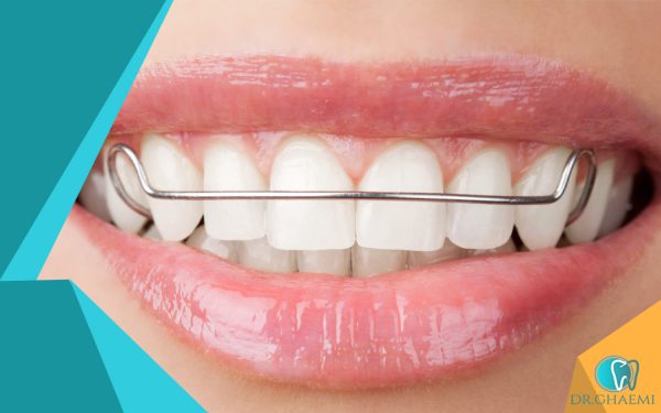آشنایی با ریتینر دندان و انواع آن
