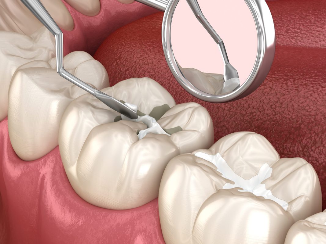 Filling root canal and tooth extraction