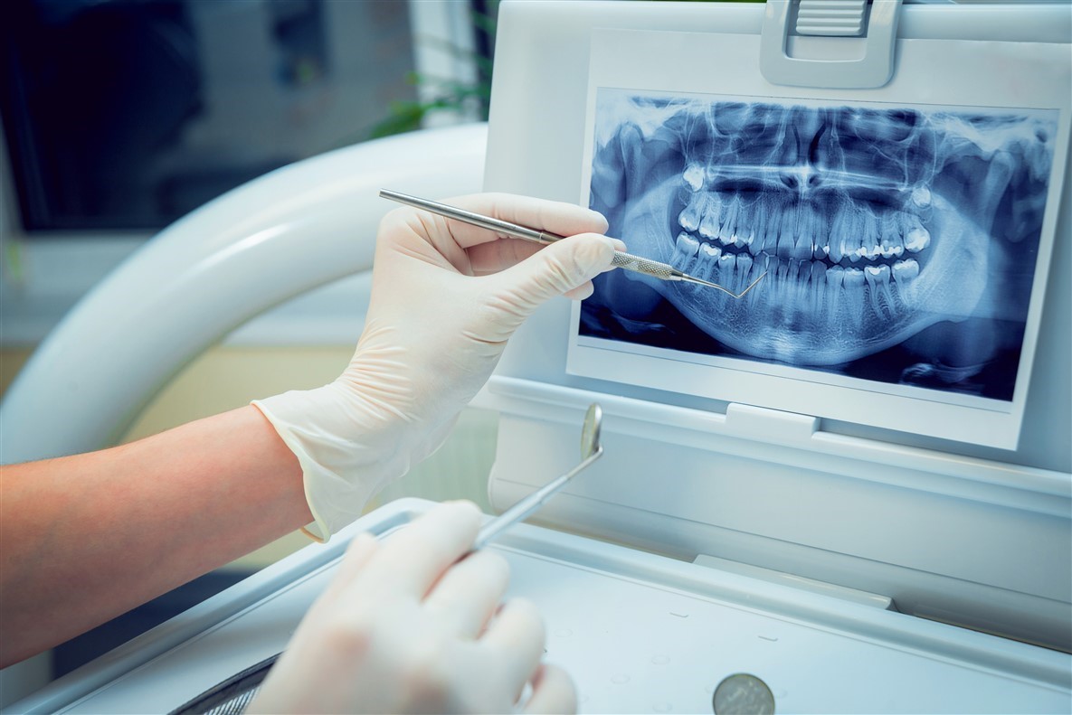 عکس برداری دندان با اشعه ایکس
