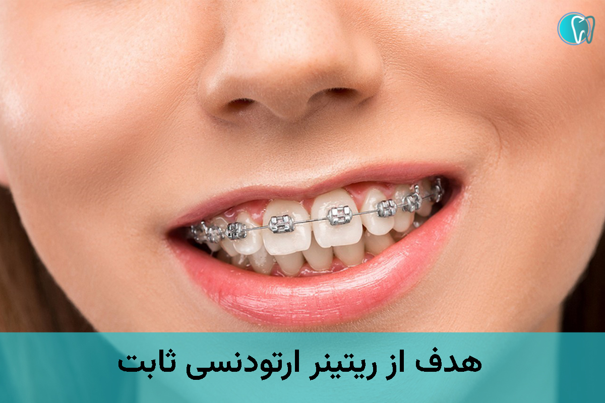 Purpose of fixed orthodontic retainer