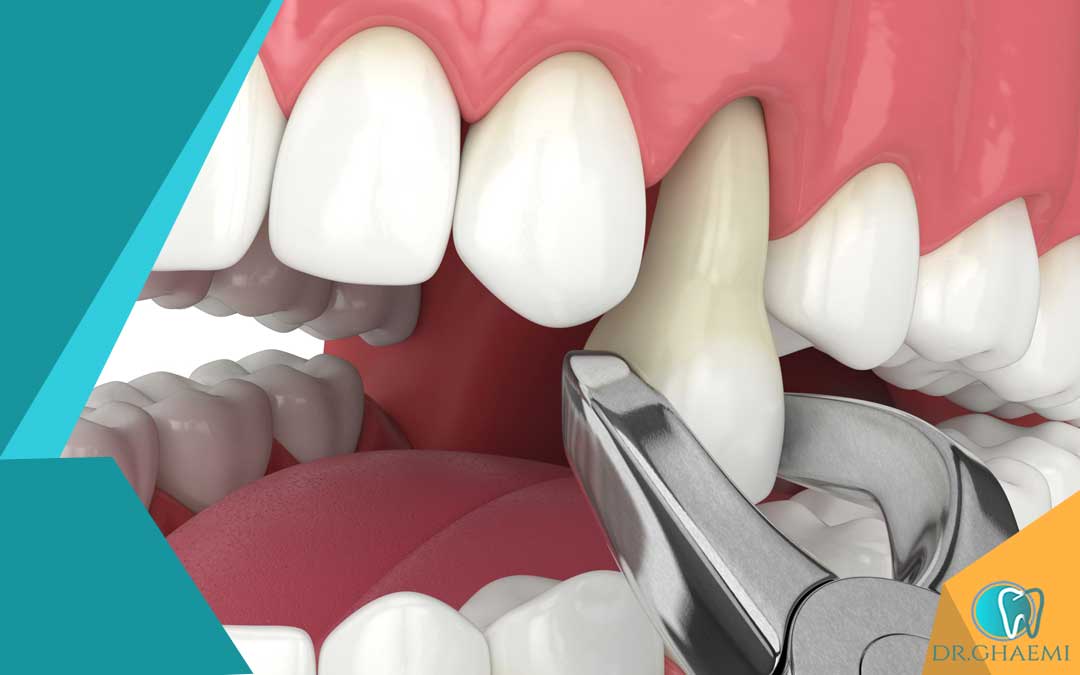 دلیل کشیدن دندان در ارتودنسی
