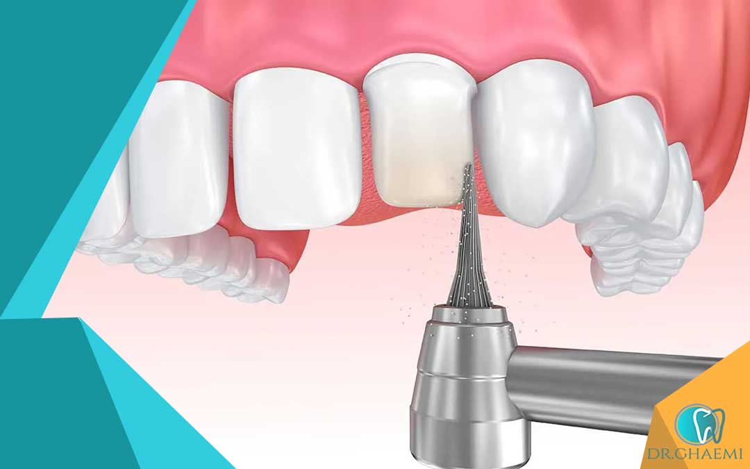 روش‌های کاهش نیاز به کشیدن دندان در ارتودنسی تراشیدن دندان 