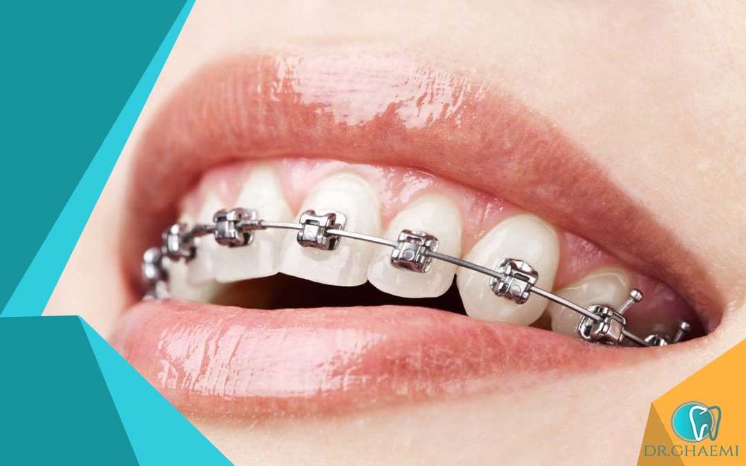 ارتودنسی بدون کشیدن دندان در دندانپزشکی قائمی