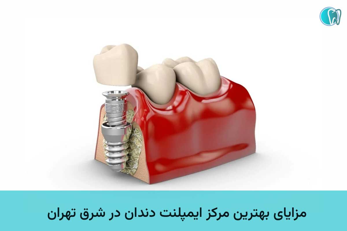 مزایای بهترین مرکز ایمپلنت دندان 