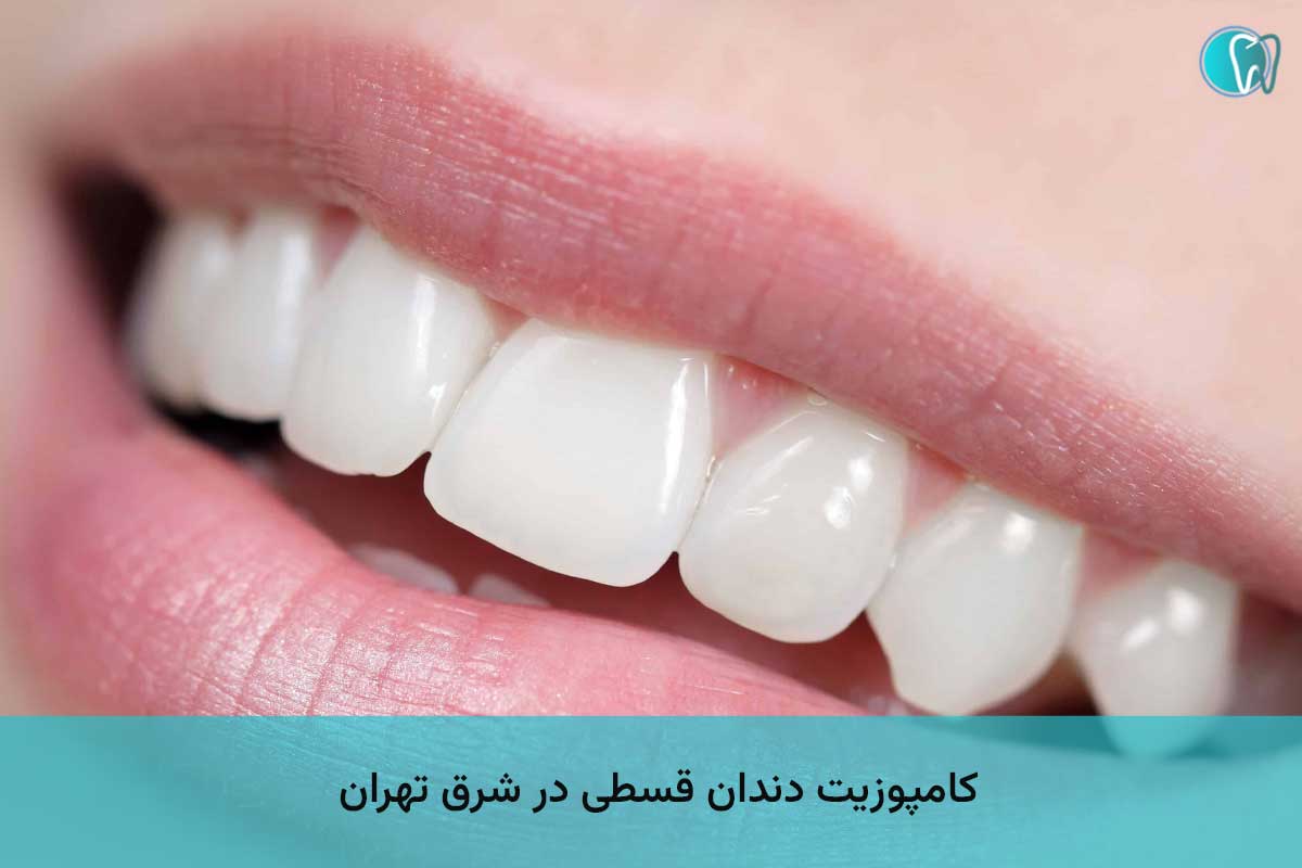 کامپوزیت دندان قسطی در شرق تهران