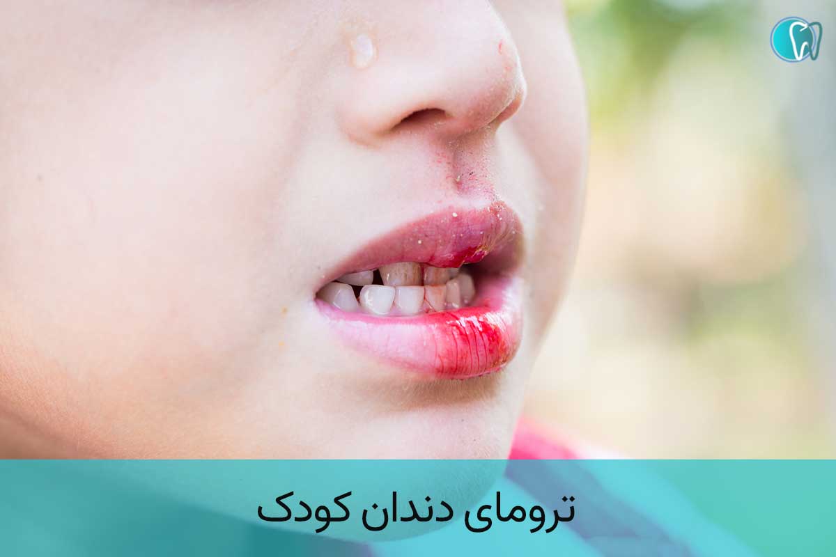 ترومای دندان کودک