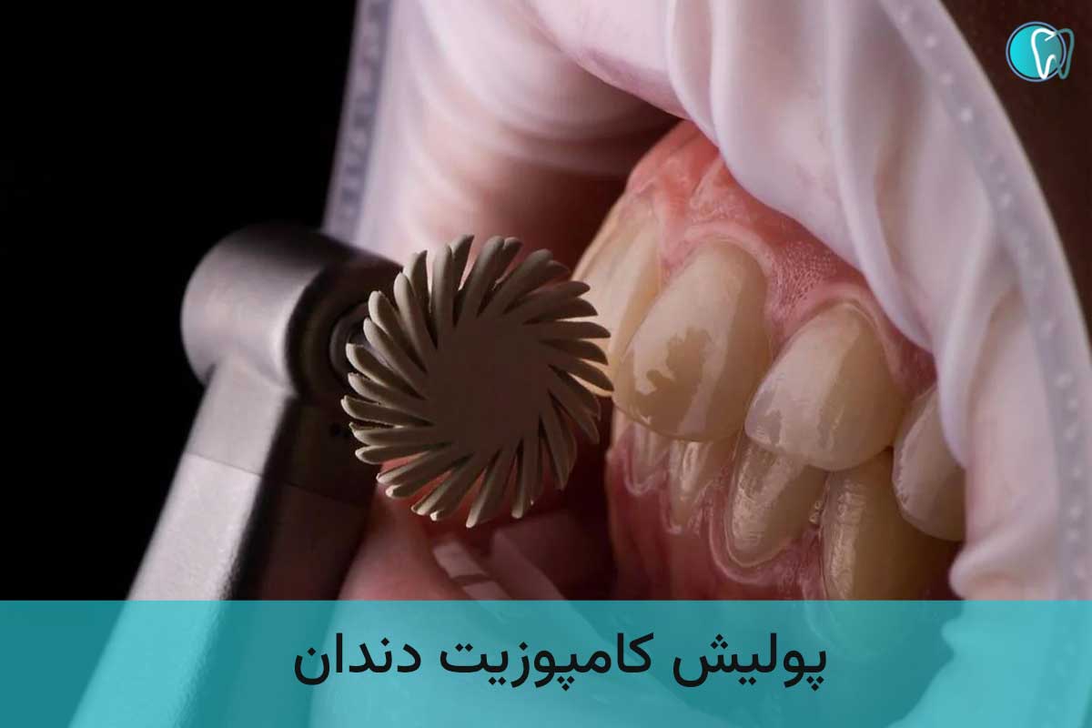 Dental composite polishing